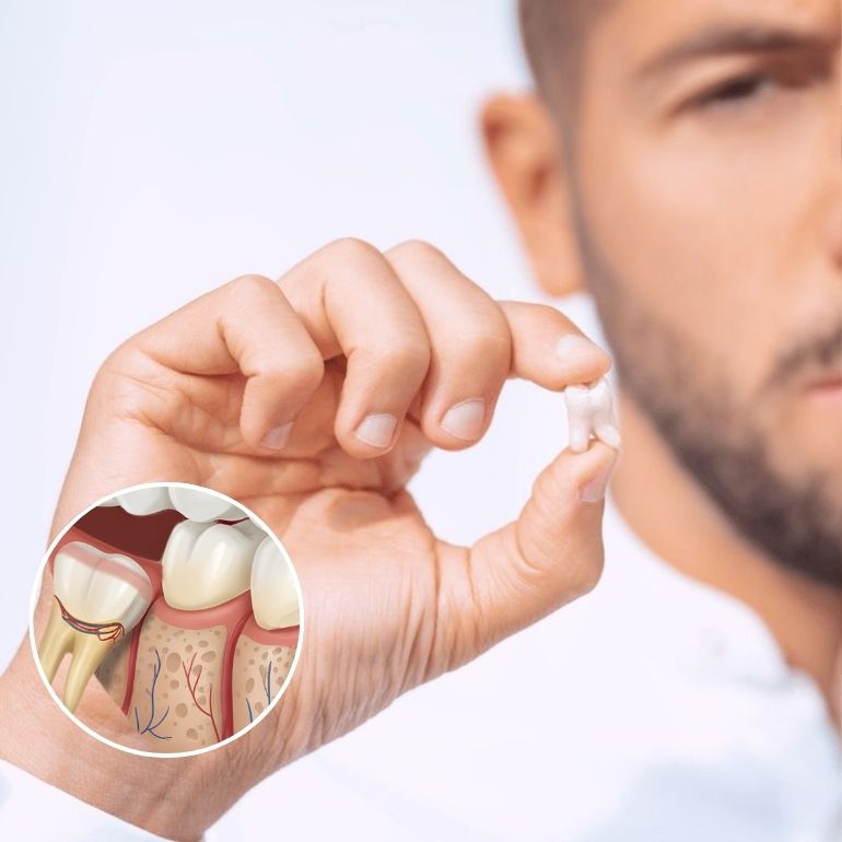 Wisdom Tooth Removal